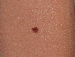 Melanoma Image 15 - Small