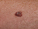 Melanoma Image 16B - Small
