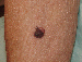 Melanoma Image 17 - Small