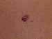 Melanoma Image 18 - Small