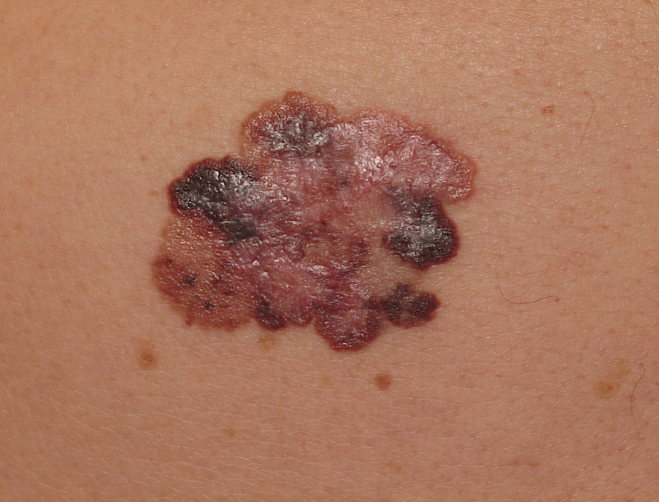 Melanoma Image 19B - Large