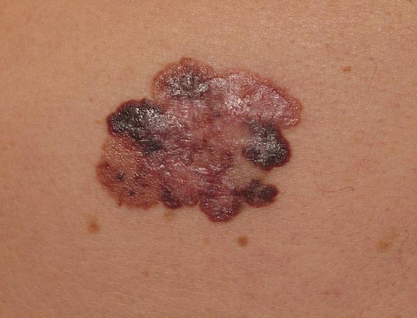 Melanoma Image 19B - Medium