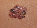 Melanoma Image 19B - Small