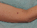 Melanoma Image 1A - Small