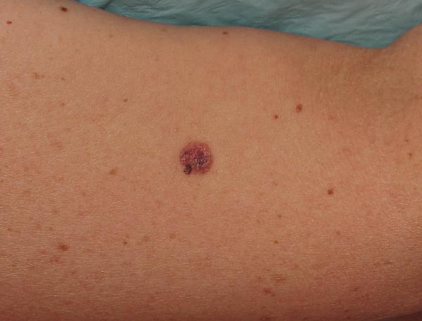 Melanoma Image 1B - Medium