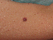 Melanoma Image 1B - Small