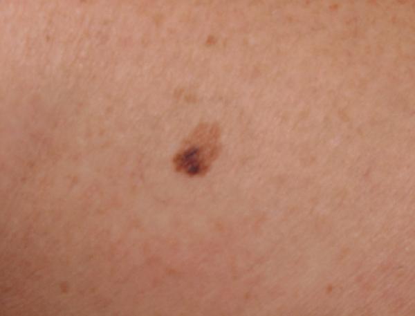 Melanoma Image 3B - Medium