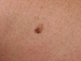 Melanoma Image 3B - Small