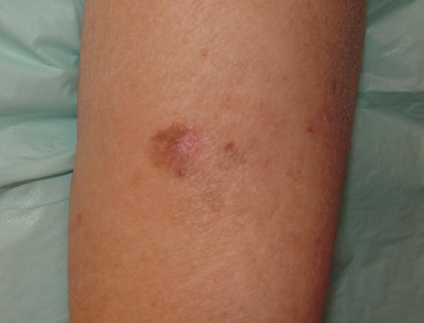 Melanoma Image 4 - Medium