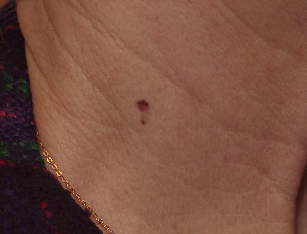 Melanoma Image 5 - Medium