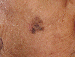 Melanoma Image 6B - Small