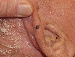 Melanoma Image 7 - Small