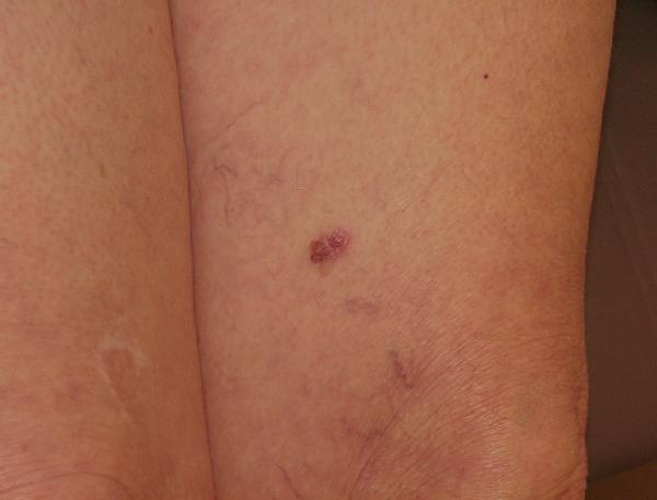 Melanoma Image 8A - Medium