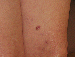 Melanoma Image 8A - Small