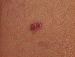 Melanoma Image 8B - Small