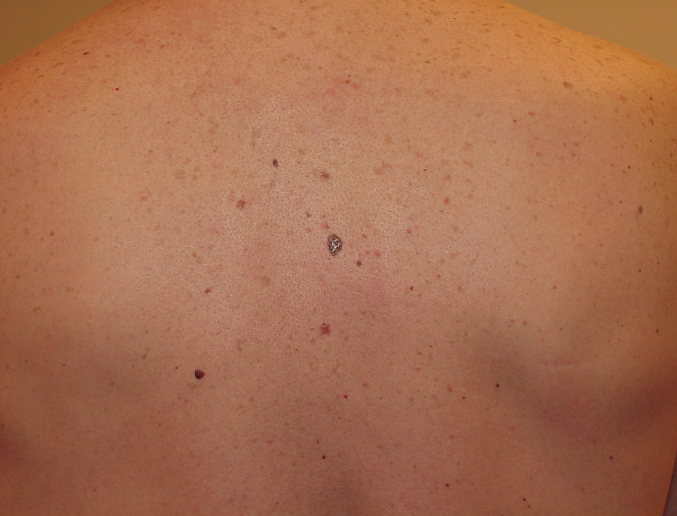 Melanoma Image 9A - Large