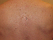 Melanoma Image 9A - Small