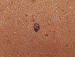 Melanoma Image 9B - Small