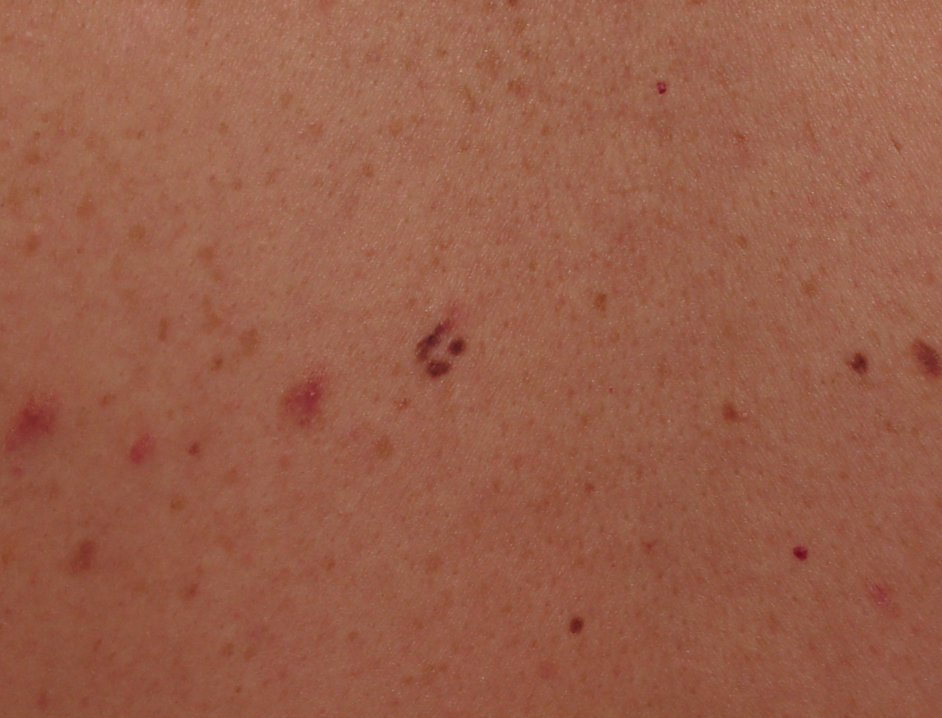 Mole Image 1C - Large