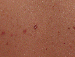 Mole Image 1C - small