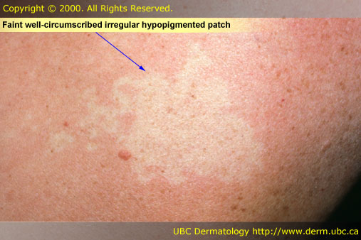 Hypopigmented