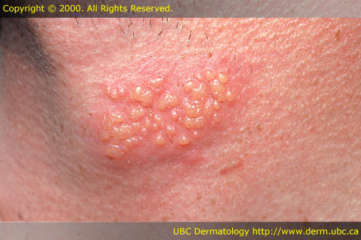 Mouth Herpes (Oral) Symptoms, Pictures, Spread, Duration ...