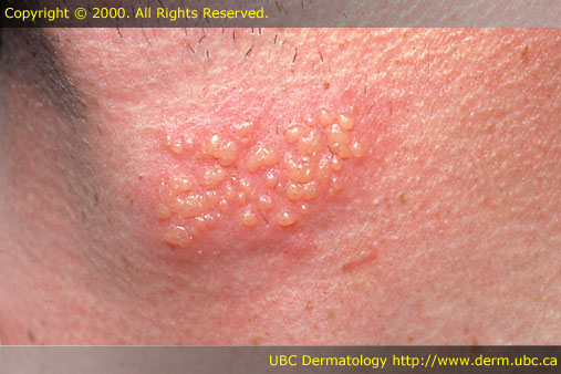 Pictures Of Herpes Sores On Buttocks - myherpestips.com