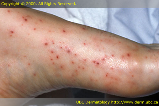 Petechiae