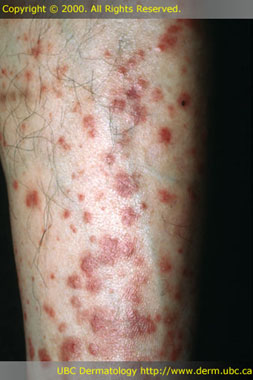 More Papules
