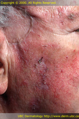 Actinic keratosis