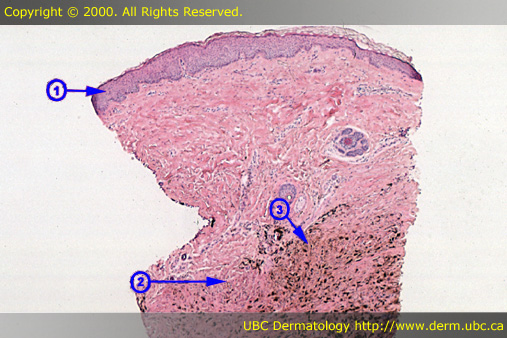 Common Blue Nevus