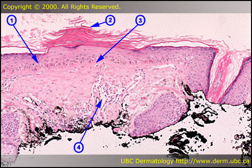 Actinic keratosis