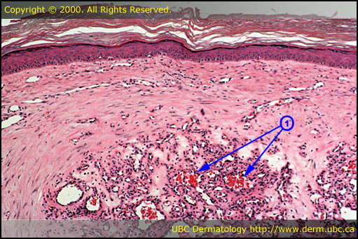 Hemangioma