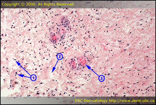 Cellulitis