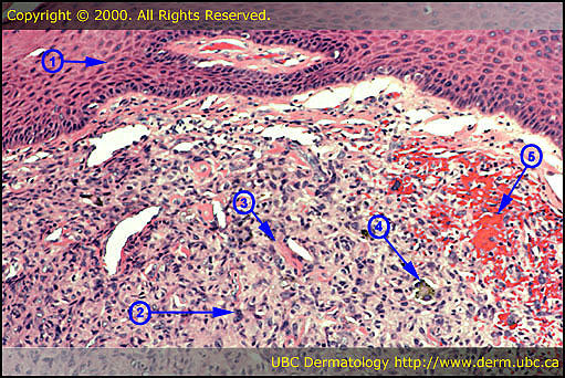 Dermatofibroma