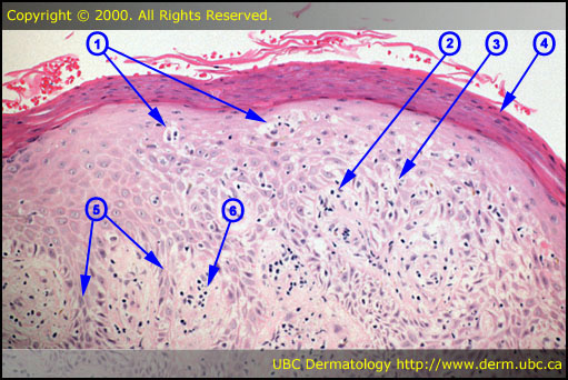 Eczema