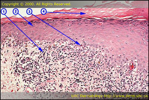 hypergranulosis - Wiktionary