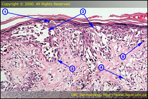 Melanoma