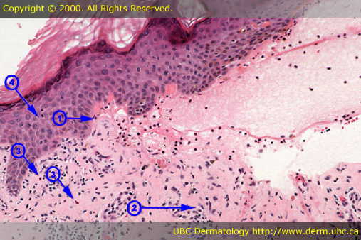 Bullous Pemphigoid