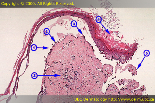 Pemphigus vulgaris