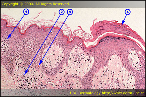 Pityriasis rosea