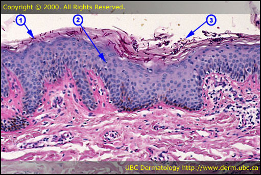 Pityriasis versicolor