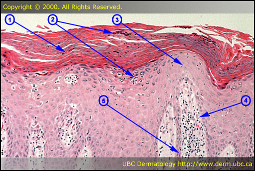 Psoriasis