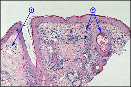 Rosacea Rosacea
