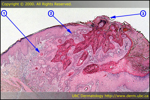 Squamous cell carcinoma