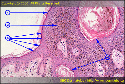 Seborrheic keratosis