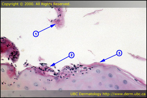 http://www.dermweb.com/pathology/graphics/annotations/tineacorp1ann.jpg