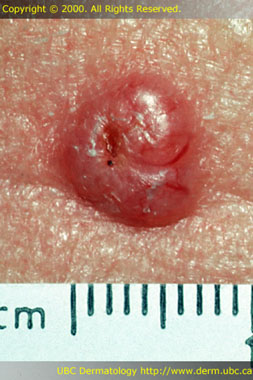 Basal cell carcinoma