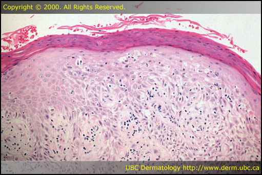 Eczema