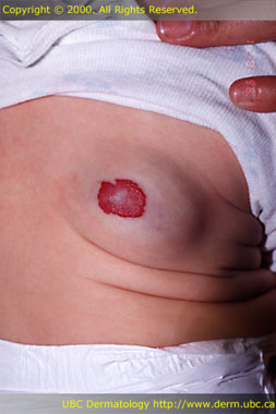 Hemangioma